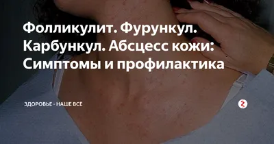 Большой Красный Прыщ Абсцесс На Коже Крупным Планом Прыщ Воспаление На Коже  Копия Пространства Инфекции — стоковые фотографии и другие картинки Белый -  iStock