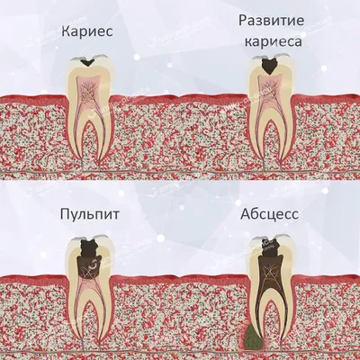 Фолликулит. Фурункул. Карбункул. Абсцесс кожи: Симптомы и профилактика |  Здоровье - НАШЕ ВСЁ | Дзен