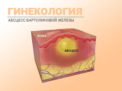 Названа диета, провоцирующая воспаление кожи и развитие псориаза