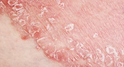 Что такое мелазма и как эффективно вылечить пигментацию на коже | Сеть  клиник ЛИНЛАЙН