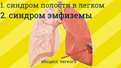 Avangard Hospital Osh - Воспаление лёгких у взрослых Это заболевание  характеризуется патологией лёгочной ткани. При этом нарушается обмен  кислородом, который происходит между воздухом и кровью. Альвеолы (воздушные  мешки) заполняются воспалительными ...