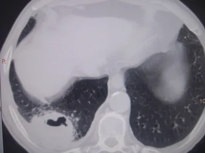 Пневмония. Что нужно знать о воспалении легких | Министерство  здравоохранения Чувашской Республики