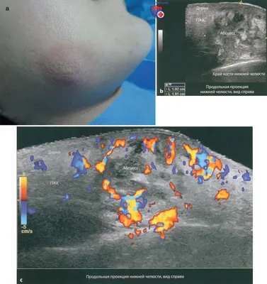 УЗИ абсцесса кожи и мягких тканей