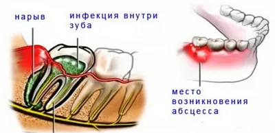 Абсцесс зуба - что такое и чем опасен | Центр Ортодонтии | Дзен