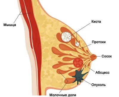 Лечение абсцесса молочной железы. НДЦ Королев