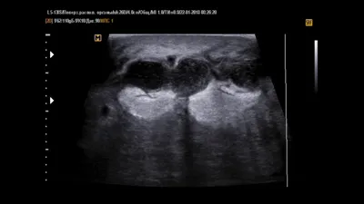 Мастит. воспаление молочной железы (образование абсцесса ). Векторное  изображение ©edesignua 191724086