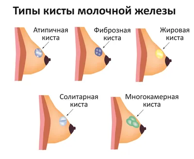 Болезненное уплотнение в груди – что это может быть? Что делать? |  Международная клиника MEDICA24 | Дзен