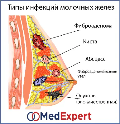 Абсцесс. Поперечное сечение молочной железы с воспалением Векторное  изображение ©edesignua 193269318