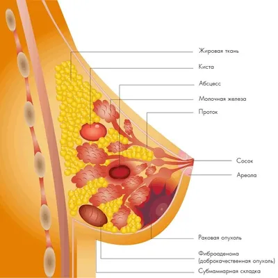 КИСТЫ МОЛОЧНОЙ ЖЕЛЕЗЫ | MED Expert