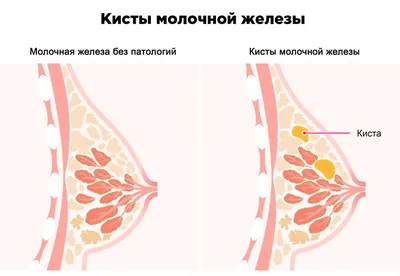 Мастопатия