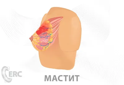 Основные болезни груди и молочных желез - о тревожных симптомах,  профилактике и лечении