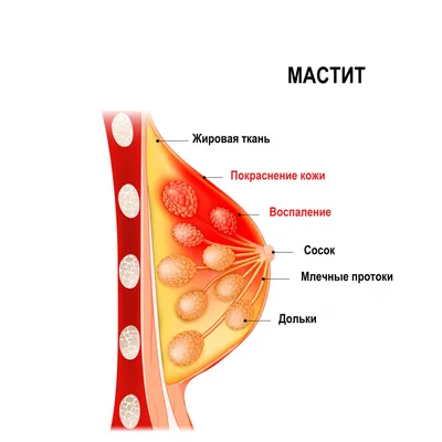 Абсцесс молочной железы - YouTube