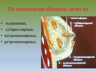 Мастит – симптомы, причины, диагностика и лечение заболевания, прогноз и  профилактика