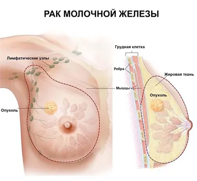 Внутритканевая маркировка опухолей молочной железы - Комсомольское-на-Амуре  подразделение КГБУЗ \"ККЦО\"