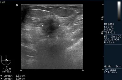 Рак молочной железы BIRADS 5 | Радиография