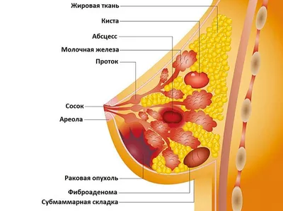 Киста молочной (грудной) железы - лечение кисты в груди у женщин