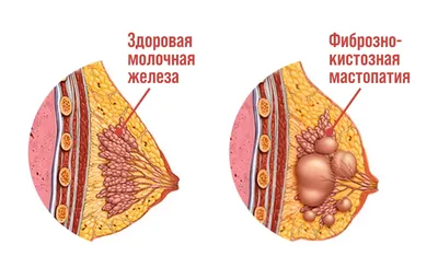 УЛЬТРАЗВУКОВОЕ ИССЛЕДОВАНИЕ КИСТОЗНЫХ ОБРАЗОВАНИЙ МОЛОЧНОЙ ЖЕЛЕЗЫ – тема  научной статьи по клинической медицине читайте бесплатно текст  научно-исследовательской работы в электронной библиотеке КиберЛенинка