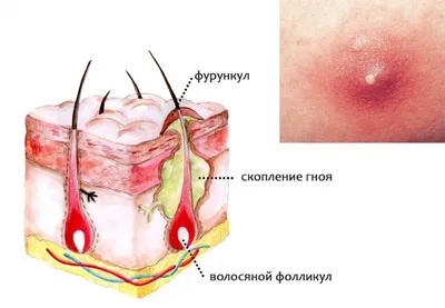 Как быстро убрать воспаление на лице: советы косметолога