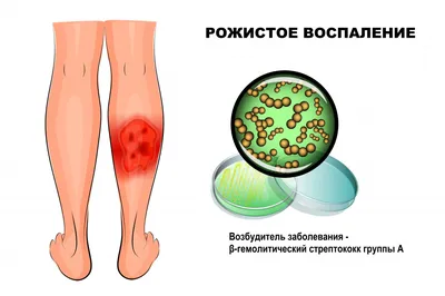 Абсцесс Крупным Планом На Детской Коже — стоковые фотографии и другие  картинки Гнойник - Гнойник, Кожа, Врач - iStock