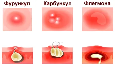 У кого были фурункулы на лице? Как лечили? - Советчица