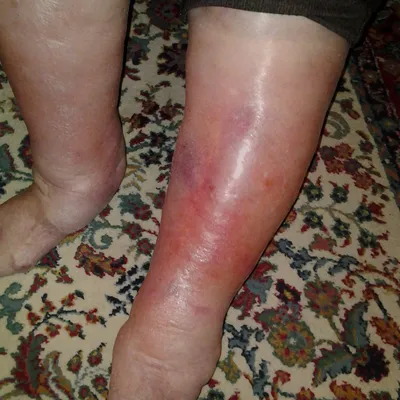 Неизбежный абсцесс с целлюлитом, или стафилококковая Streptococcal инфекции  кожи в ноге футбольной бирманского мужчины Стоковое Фото - изображение  насчитывающей мьянма, убыток: 187004624