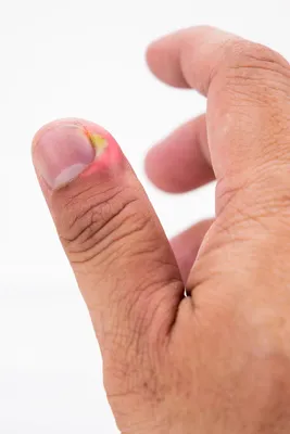 🦠Панариций ⠀ Это гнойное воспаление мягких тканей пальцев рук и реже  пальцев ног, в области основания ногтевой пластины. ⠀ Проблема… | Instagram