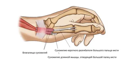 Эпикондилит локтевого сустава: воспаление сустава и лечение - Центр доктора  Бубновского