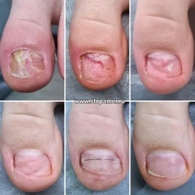Лечение воспаления ногтевого валика ✓ Авторские статьи Клиники Подологии
