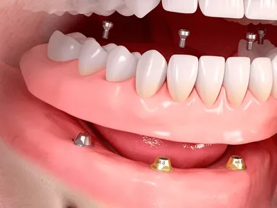 Болит зуб после удаления нерва: причины и лечение — ROOTT