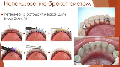 Причины рецидива небного абсцесса при патологии верхних моляров и  премоляров - online presentation