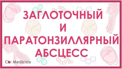 Тонзиллит: симптомы, причины, диагностика и лечение | Блог ЛДЦ Здоровье