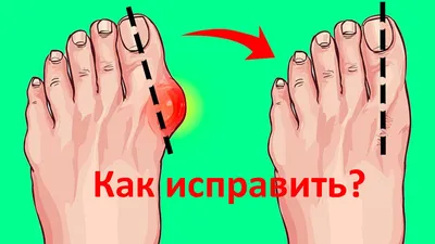 Подагра фото на ногах: фото, причины, симптомы, диагностика и лечение  подагры в Москве