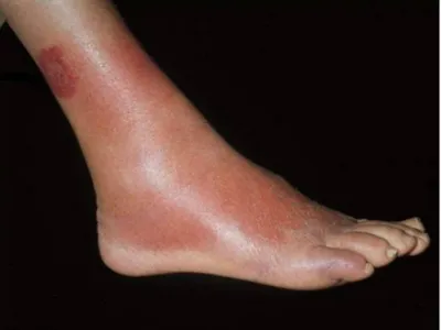 воспаление женской ноги красным пятном. концепция ног боль и болезнь  Стоковое Изображение - изображение насчитывающей воспаление, пациент:  265213829