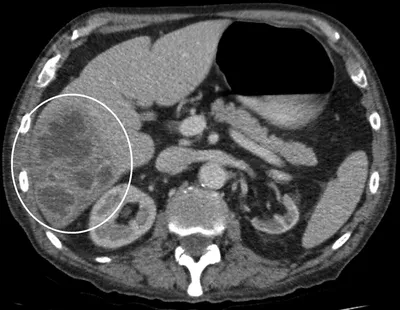 Абсцесс печени: как халява чуть не стоила жизни | Гроб Клетов заметки  рентгенолога | Дзен