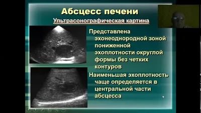 Абсцесс печени – причины, симптомы, диагностика и лечение у взрослых |  «Будь Здоров»