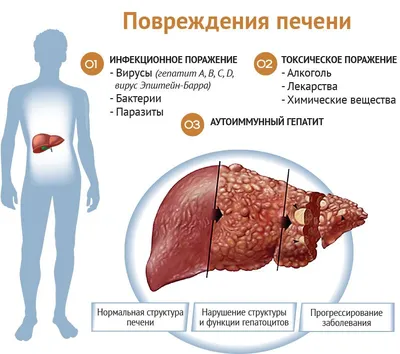 Абсцесс печени: что это, почему он возникает и насколько опасен | О  здоровье: с медицинского на русский | Дзен