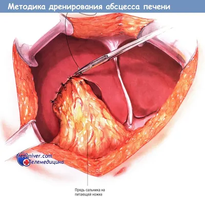 Абсцессы... они разные бывают. Печень | Пикабу