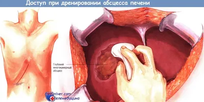 Абсцесс печени: причины, диагностика и лечение | Медицинский университет  инноваций и развития | Дзен