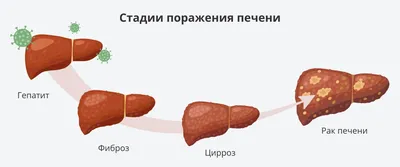 Доступ и ход операции дренирования абсцесса печени