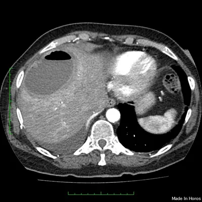 Абсцесс печени | Радиография