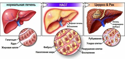 Презентация на тему: Абсцесс печени