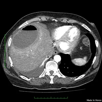 Абсцесс печени | Радиография