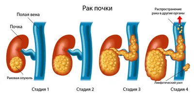 Пиелонефрит: симптомы, лечение, что это такое, диета, причины