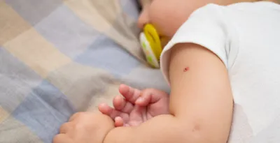 Случай с омертвлением участка кожи у младенца после прививки расследует  Минздрав Якутии | 26.10.2023 | Якутск - БезФормата