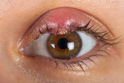 Покраснение века глаза: причины, диагностика и лечение