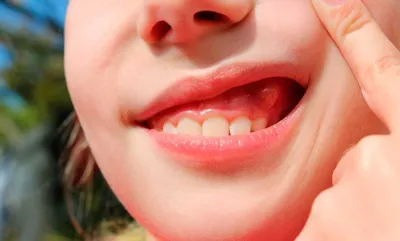 Абсцесс зуба - что такое, причины, симптомы. Как удалить гнойник