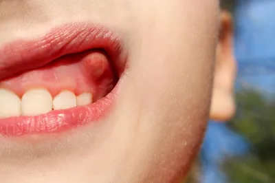 Абсцесс зуба: симптомы и лечение в домашних условиях