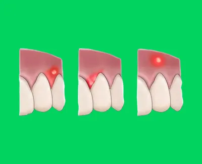 Абсцесс зуба - что такое абсцесс зуба: причины, лечение, симптомы