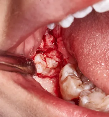 Атравматичное удаление зачатков «восьмых» зубов :: NORD DENTAL — семейная  стоматология. Две клиники на севере Петербурга