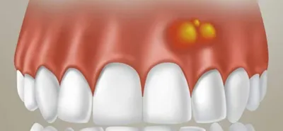 Гнойник на десне (абсцесс десны, зуба) – что делать, виды, методы лечения